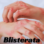 Blisterata